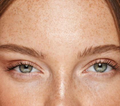 Brow lift: A photo shows the upper part of the face of a ginger girl with blue eyes after the brow lift.