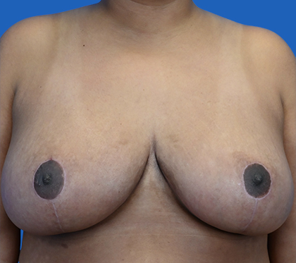 Brest reduction in Longview Plastic Surgery: after the intervention.