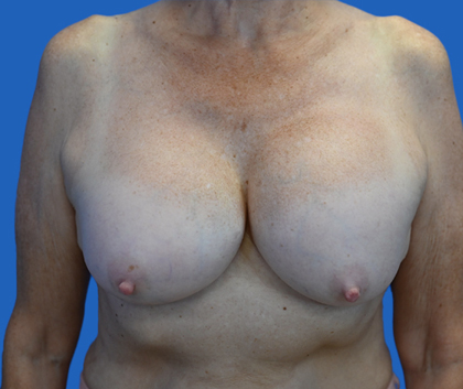 Exchange Capsulectomy Ruptured: An image with a blue background shows a woman