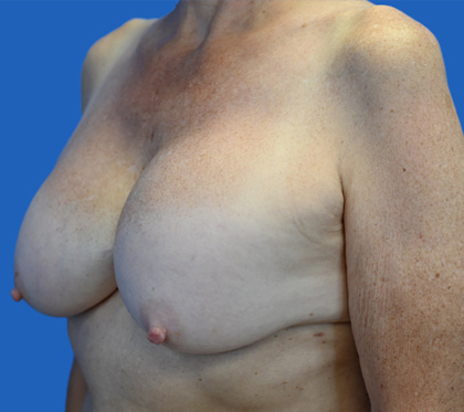 Exchange Capsulectomy Ruptured: An image with a blue background shows a woman