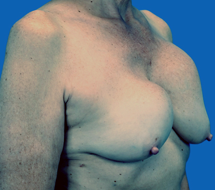 Breast Implant Exchange: An image with a blue background shows a woman