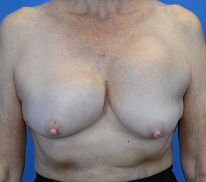 Exchange Capsulectomy Ruptured: An image with a blue background shows a woman