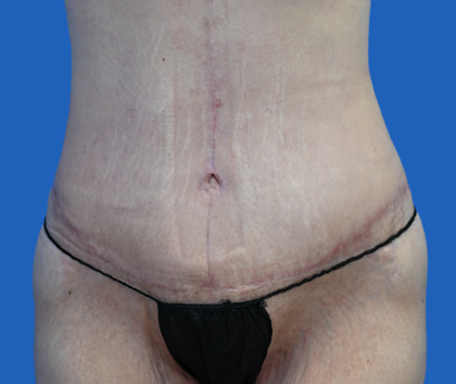 abdominoplasty - a photo of a woman