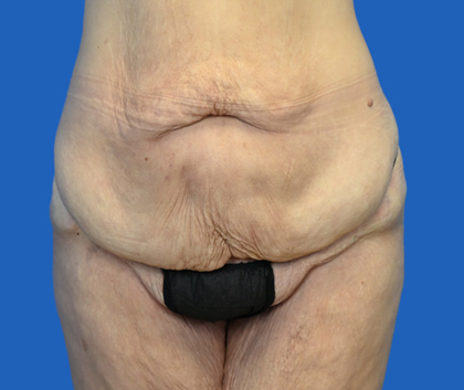 abdominoplasty - a photo of a woman