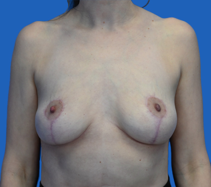 implant removal: An image with a blue background shows a woman