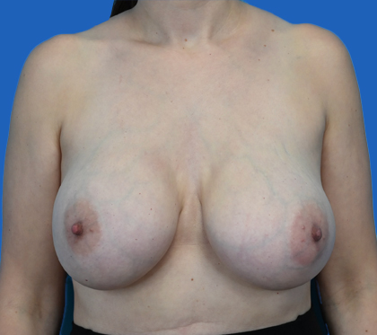 implant removal:An image with a blue background shows a woman