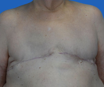 Masectomy scar revision - a photo shows an upper part of woman