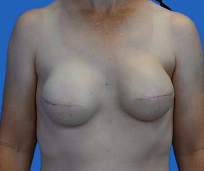 Breast reconstruction: An image with a blue background shows a woman