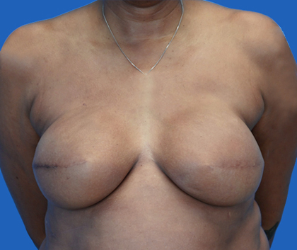 Breast reconstruction: An image with a blue background shows a woman