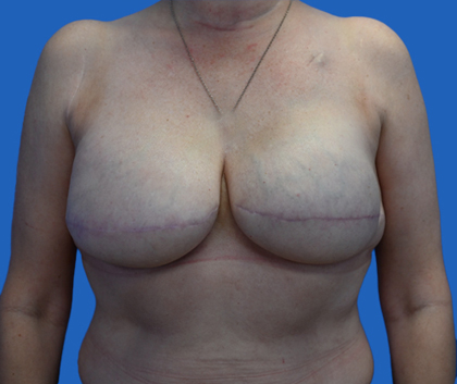 Breast reduction: An image with a blue background shows a woman