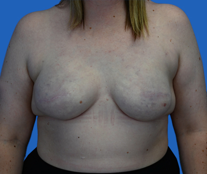 Breast reduction: An image with a blue background shows a woman