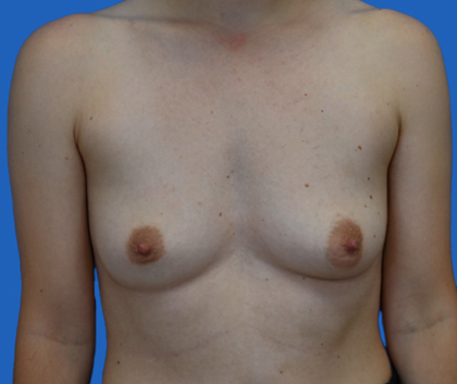 Breast reconstruction: An image with a blue background shows a woman