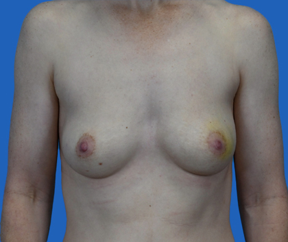 Breast reconstruction: An image with a blue background shows a woman