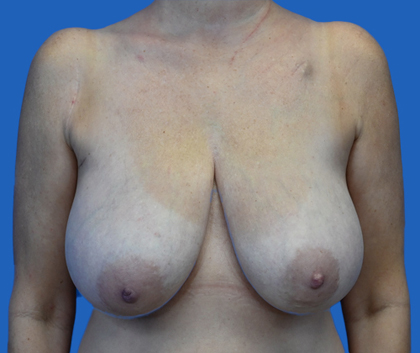 Breast reconstruction: An image with a blue background shows a woman