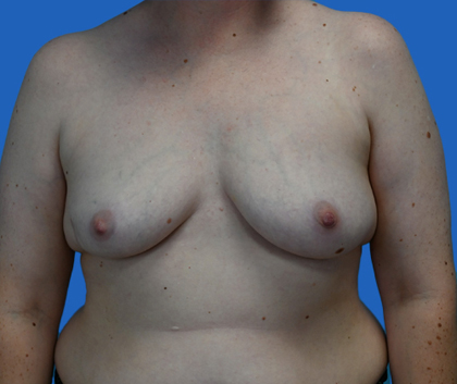 Breast reduction: An image with a blue background shows a woman