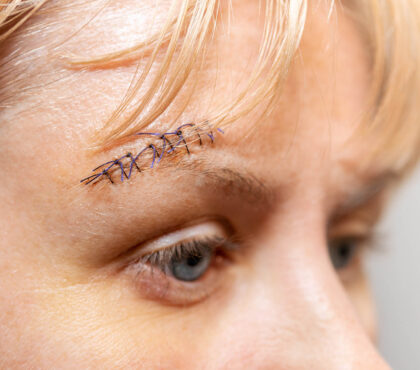 medical suture with protruding threads on a woman face near the eyebrow, close-up