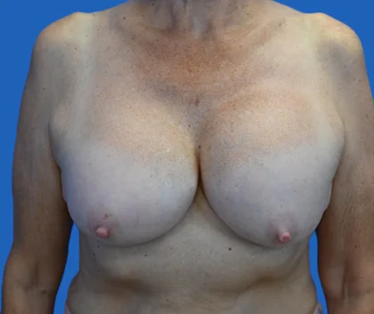 Exchange Capsulectomy Ruptured: An image with a blue background shows a woman