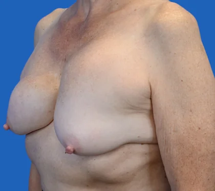 Exchange Capsulectomy Ruptured: An image with a blue background shows a woman