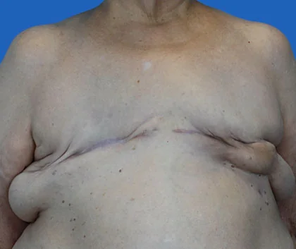 Masectomy scar revision - a photo shows an upper part of woman